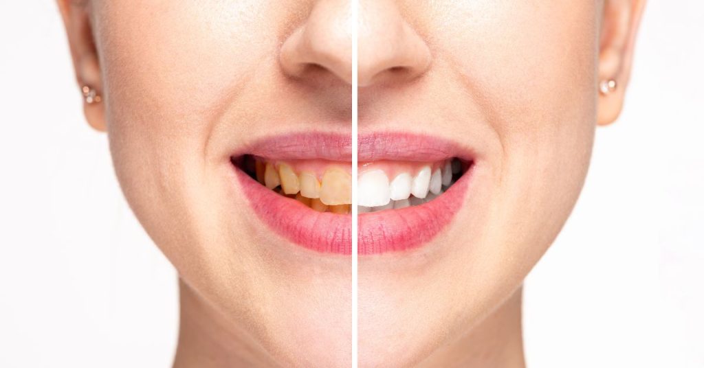 ¿Cómo prevenir los dientes amarillos?